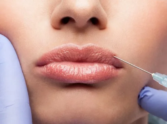 Lip Filler en Medellín - Dra. Catalina Henao